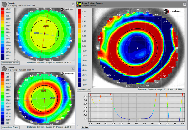 REORDER your Ortho K (Orthokeratology) lenses - Enhance your current vision to new potentials with the latest ortho k lens advancements in 2024 DCL